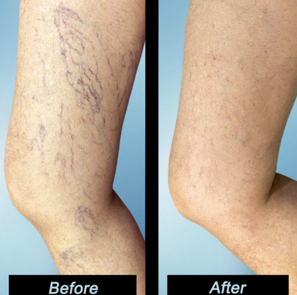 Cosmetic spider vein treatment in Downers Grove, IL