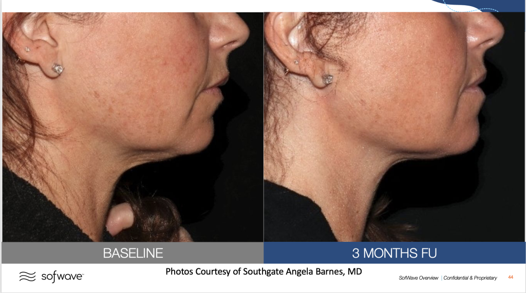 Before & After image of submental by MD Aesthetics & Skin Tightening