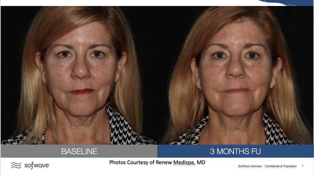 Before & After image of full face tightening by MD Aesthetics & Skin Tightening