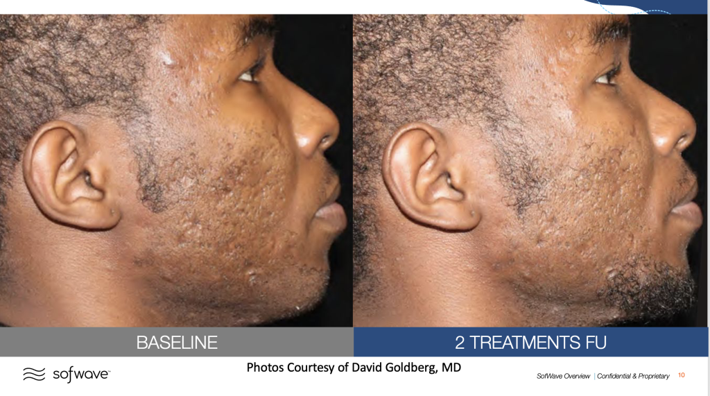 Before & After images of acne scars treatment by MD Aesthetics & Skin Tightening