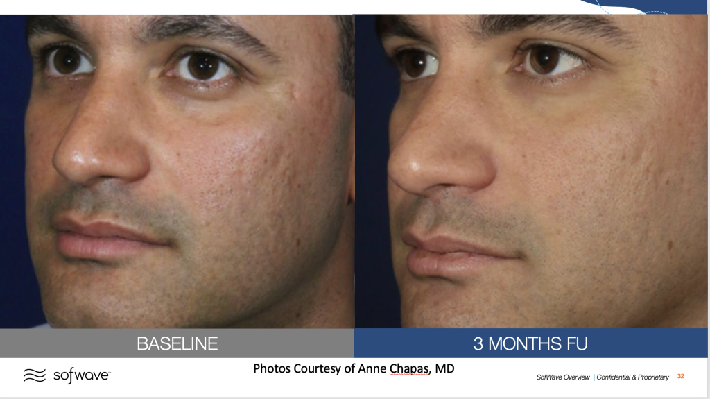 Before & After image of acne scars treatment by MD Aesthetics & Skin Tightening