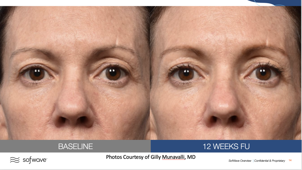 Before & After image of eyelids tightening by MD Aesthetics & Skin Tightening