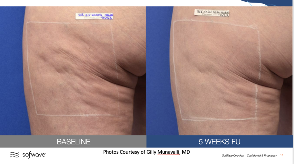 Cellulite treatment by MD Aesthetics & Skin Tightening