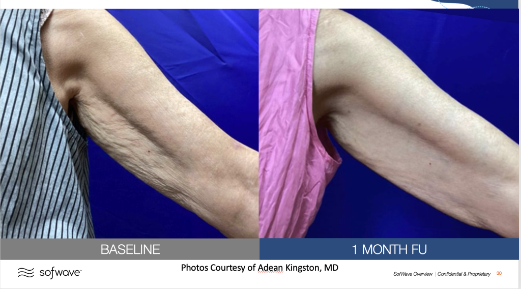 Before & After image of upper arms skin tightening by MD Aesthetics & Skin Tightening
