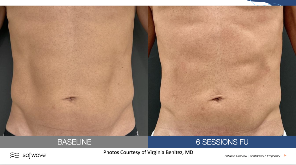Before & After image of muscle toning by MD Aesthetics & Skin Tightening