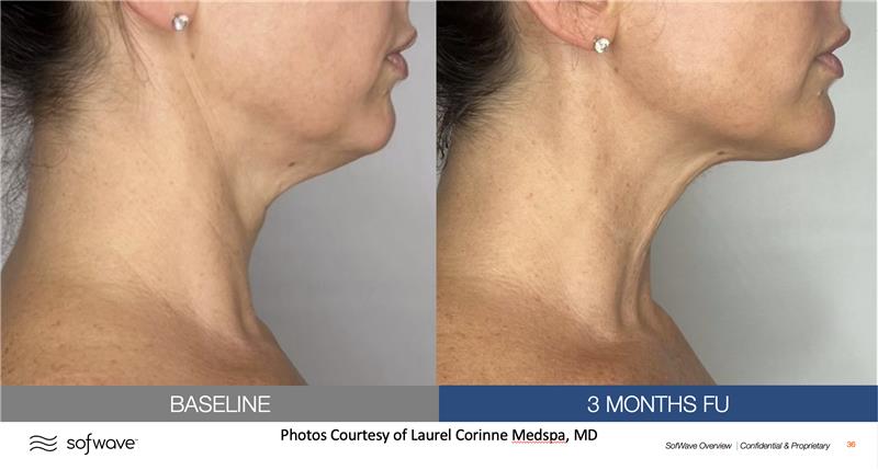 Before & After image of submental by MD Aesthetics & Skin Tightening