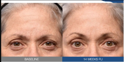 Before & After image of eyelid tightening by MD Aesthetics & Skin Tightening